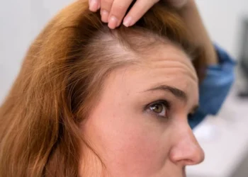 Transplante capilar ajuda a tratar a alopecia androgenética