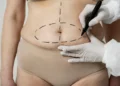 Abdominoplastia pode ir além da estética e melhorar a saúde e a qualidade de vida