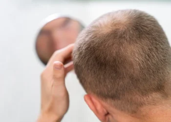 Pós-graduação em transplante capilar acompanha mercado que não para de crescer